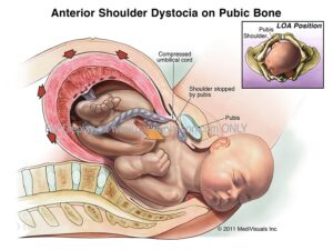 Types Of Birth Injuries Shoulder Dystocia lT Z Fo8HXcKiM