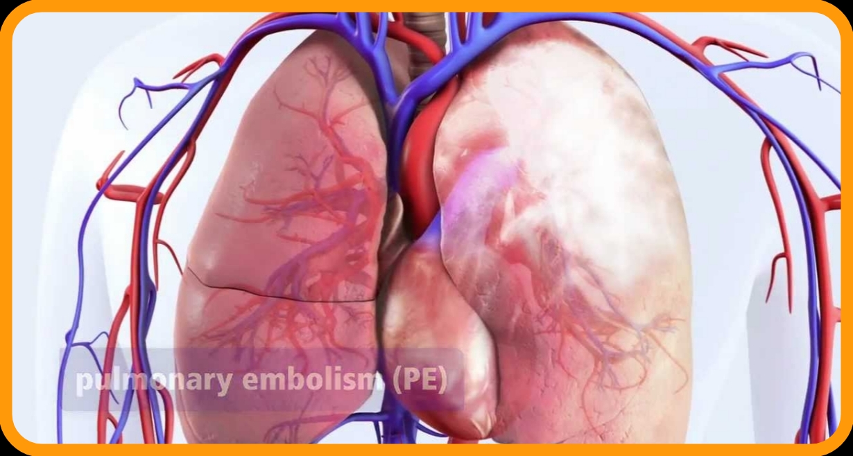 “Pulmonary Embolism:  Symptoms and Prevention”