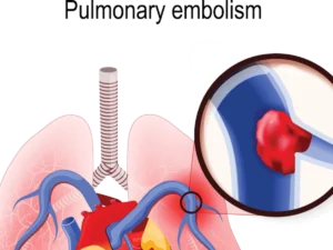 Pulmonary Embolism Type Cause Symptoms Treatment 54339727